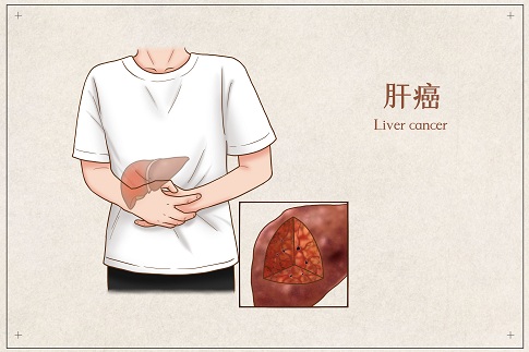 1653236443277979.jpg 攝圖網_401794893_banner_肝癌醫(yī)療插畫(企業(yè)商用).jpg