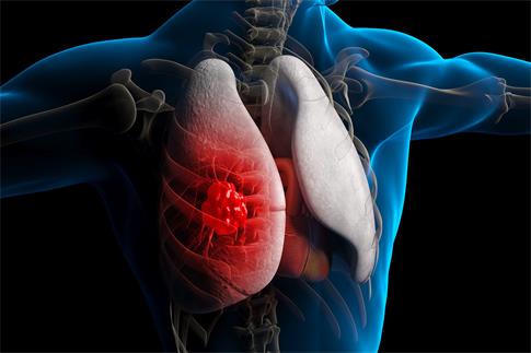 1671841864923621.jpg 攝圖網(wǎng)_401907175_banner_肺病肺癌3D疾病場(chǎng)景(非企業(yè)商用).jpg