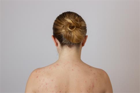 1689642279145858.jpg 攝圖網_503172280_有粉刺的年輕女孩背部有紅點(企業商用).jpg