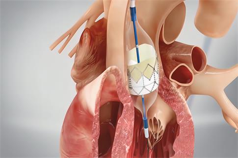 1700609890163500.jpg 攝圖網(wǎng)_330241749_冠心血管成形術(shù)和刺塞插入導(dǎo)尿藥品程序心臟病學(xué)支架閥門醫(yī)療插圖手術(shù)形術(shù)(企業(yè)商用).jpg