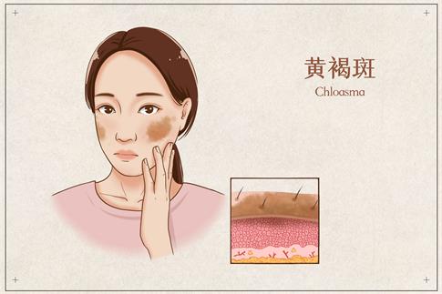 1707181953925538.jpg 攝圖網(wǎng)_401867188_黃褐斑醫(yī)療插畫(huà)(企業(yè)商用).jpg