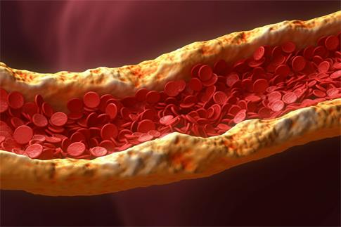 1710321295402066.jpg 攝圖網_600221639_冠狀動脈硬化(企業商用).jpg